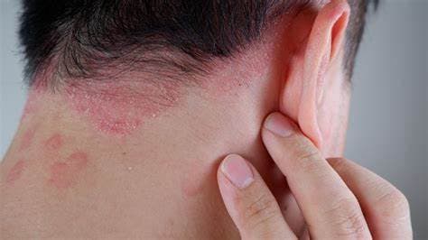 Understanding Psoriasis: Exploring Treatment Options