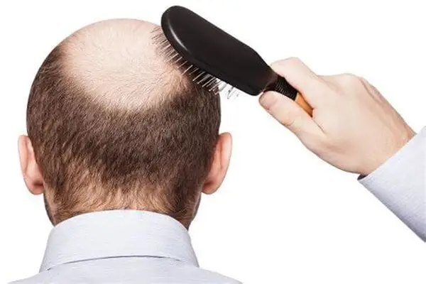 4 Proven and Research-Backed Ways to Reduce Hair Thinning