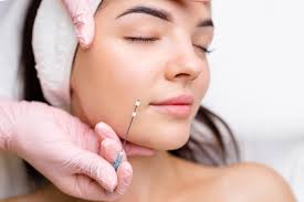 Experience the Rejuvenating Effects of PDO Thread Lifts—No Surgery Required