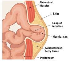 hernia.jpg