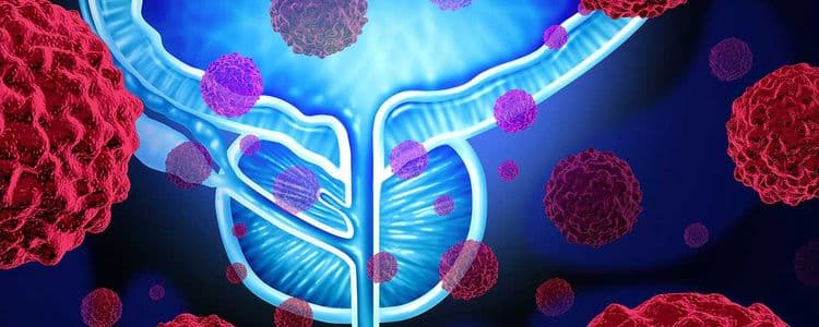 5 Medications You Might Be Taking That Can Cause Bladder Cancer