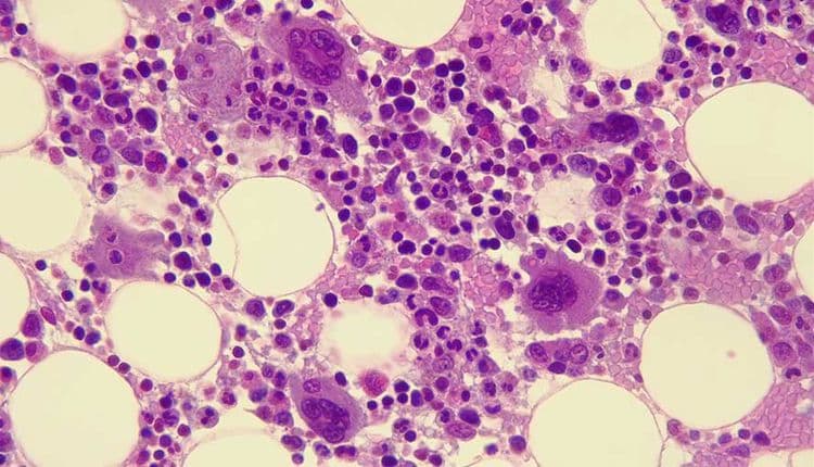 Understanding Myelodysplastic Syndromes (MDS): The Early Warning Signs