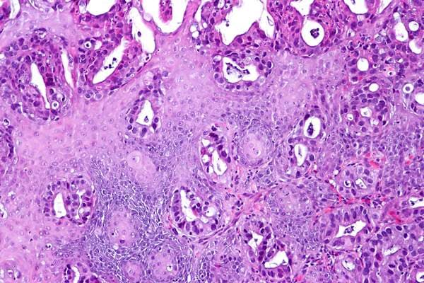 Prostate-Specific Antigen Levels: What’s Normal for a 70-Year-Old Man?