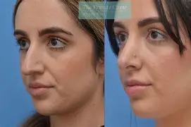 7 Nose Reshaping Approaches Shaping 2026