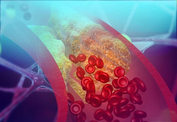 Everything You Need to Know about Blood Clots: Causes, Signs and Symptoms, Treatments, and More