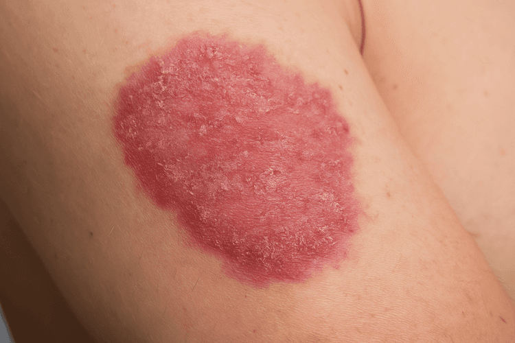 How to Spot Mycosis Fungoides Early: What This Rash Really Looks Like