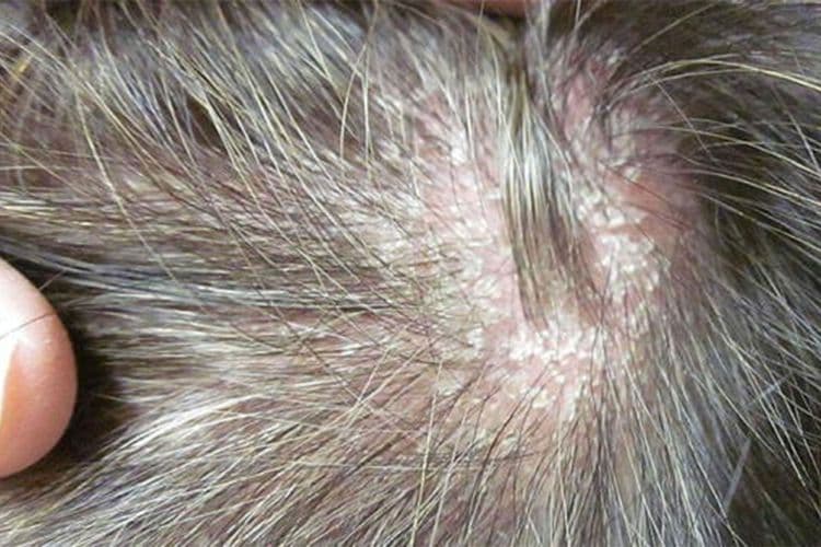 Here's What Scalp Psoriasis Looks Like: A Visual & Symptom Guide