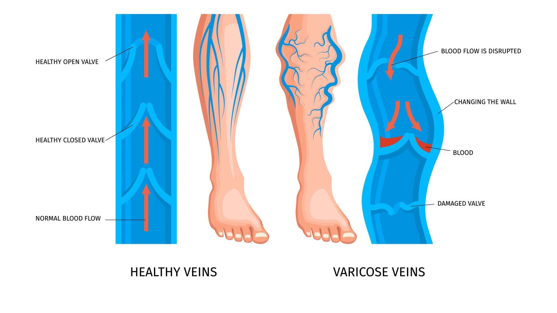 varicoe-veins-complication.jpg